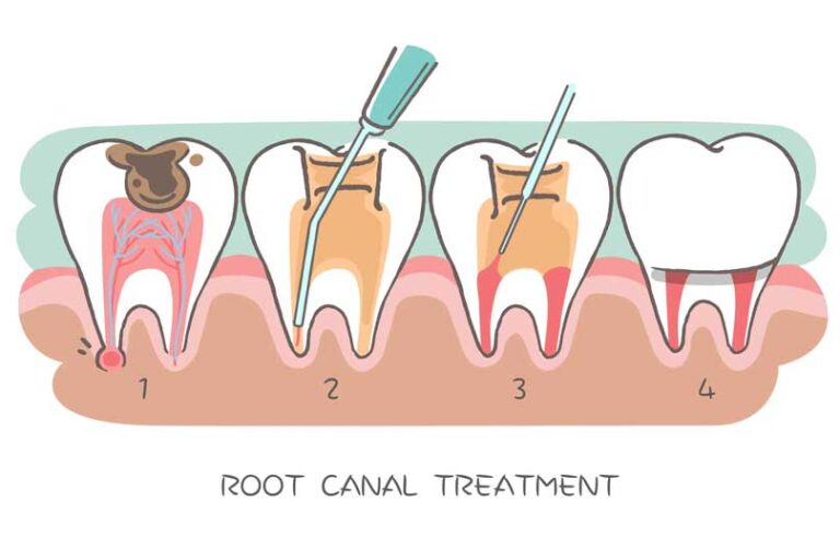 Your Guide to Aftercare Following a Root Canal