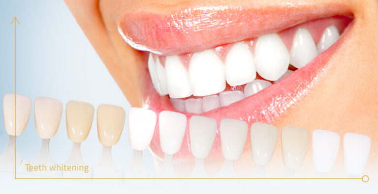 Caring for Your Bright New Smile: Post-Whitening Instructions