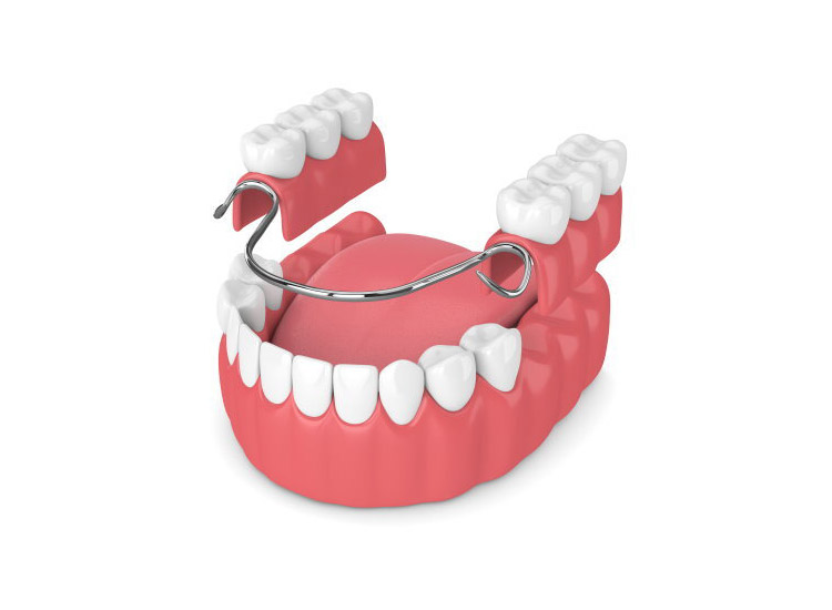 Partial Denures: An Aftercare Guide for El Paso Patients